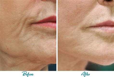 Profound RF Skin Tightening .